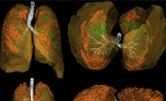 Pulmonary Embolism Trajectory Prediction Using Machine Learning